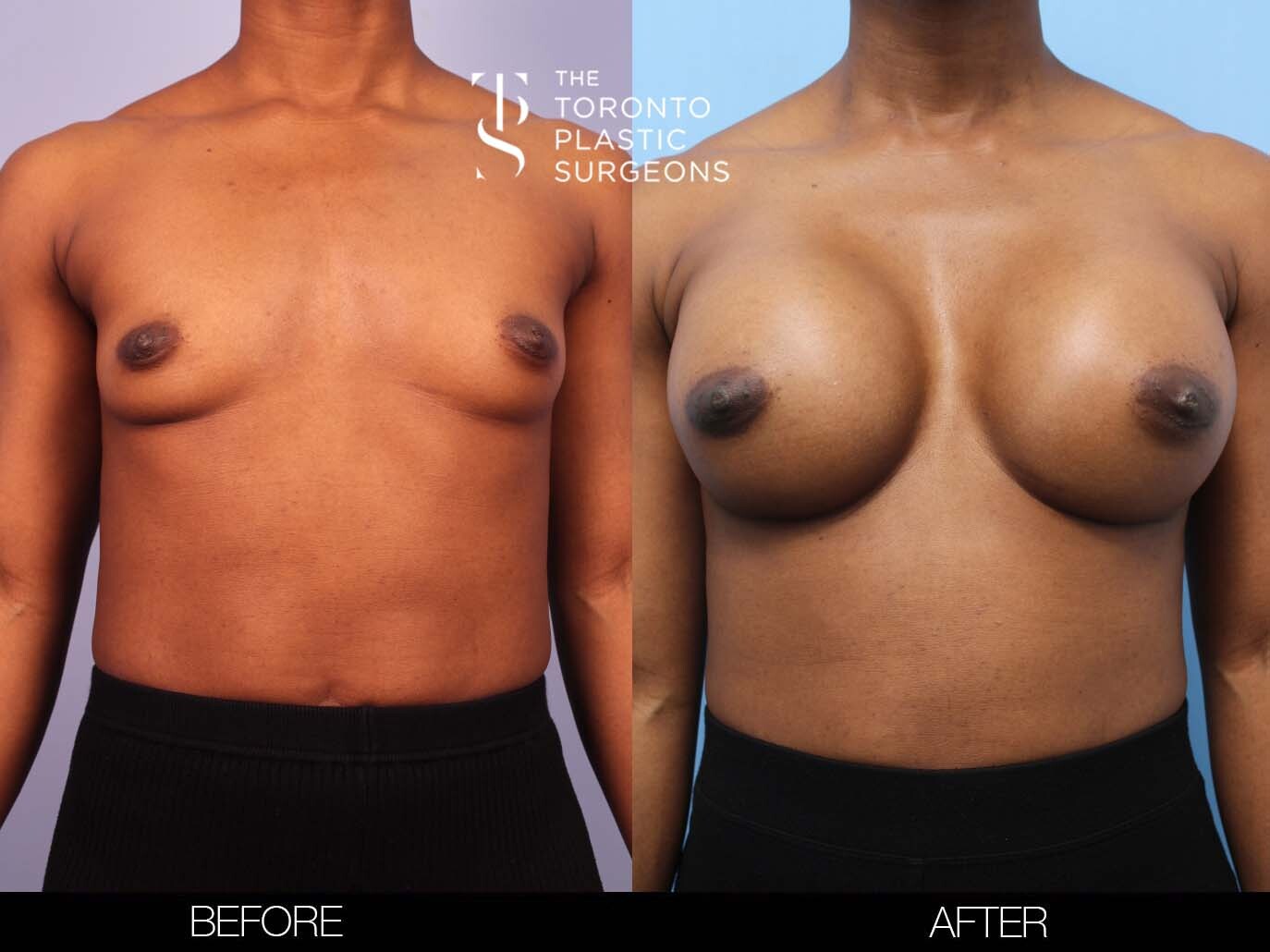 Whats the Difference: Fake Boobs vs. Real Boobs