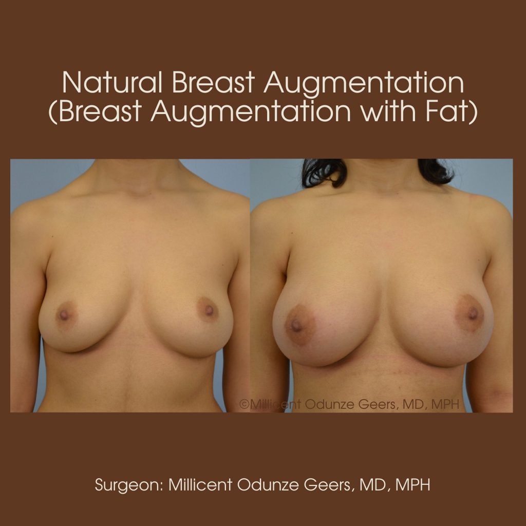 Natural Breast Augmentation Before and After Photos