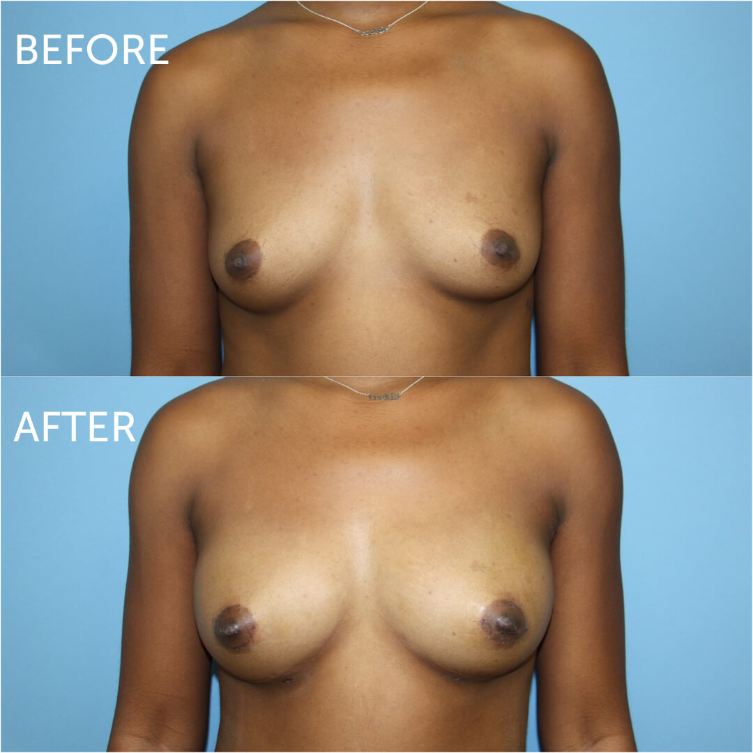 Natural Breast Augmentation: Why Choose Fat Transfer Method