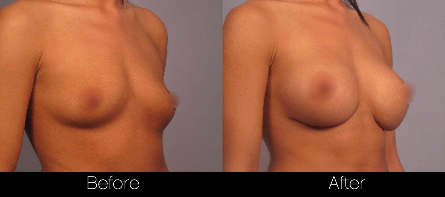 Tips for Achieving Natural-Looking Breast Implants