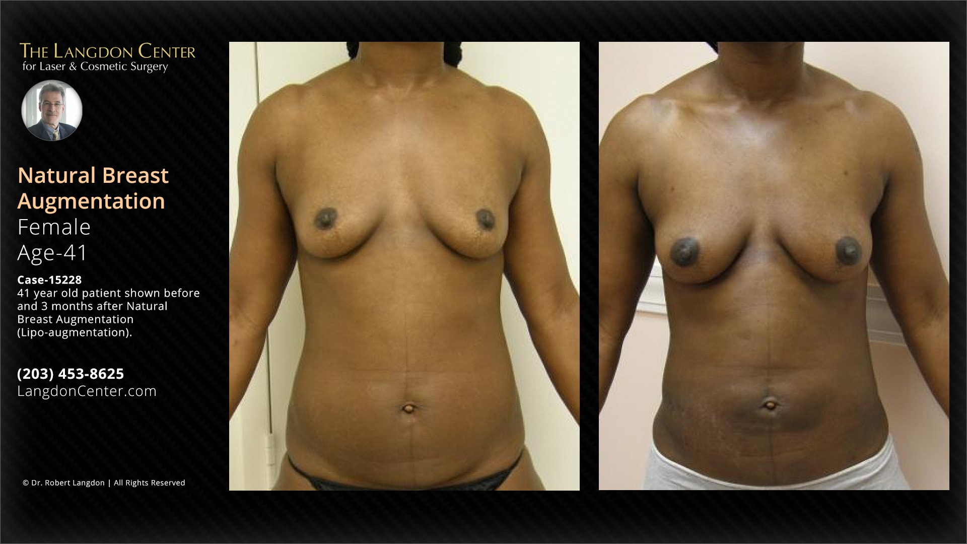 Natural Breast Augmentation