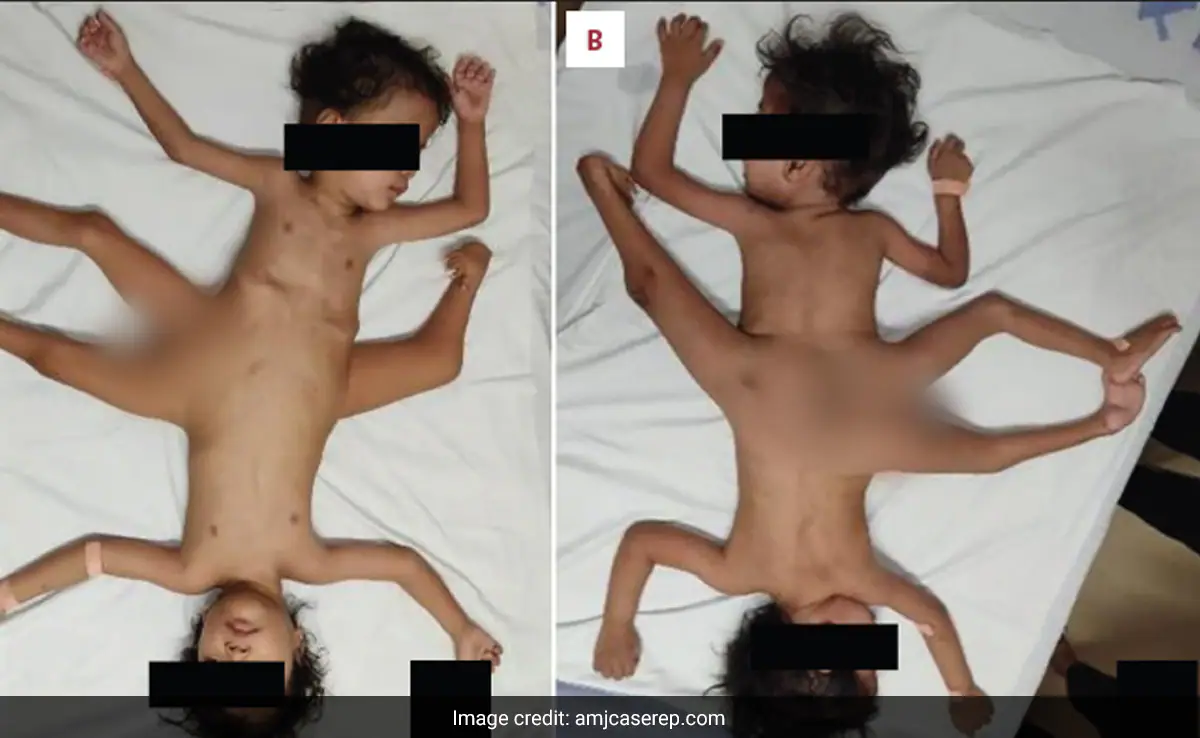 Extremely Rare Conjoined Twins Born In Indonesia Have 4 Arms 3 Legs