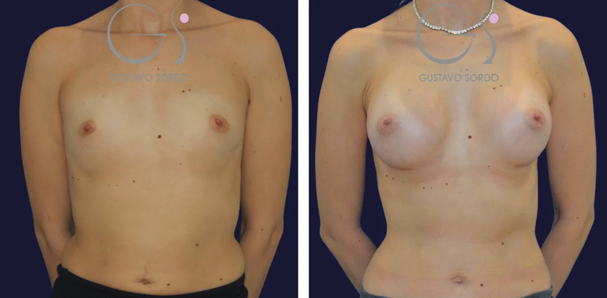 250-255cc Before and After Breast Augmentation Implants