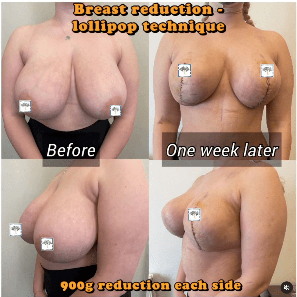 Breast Reduction Before and After Photos: Look Out for These 6 Things