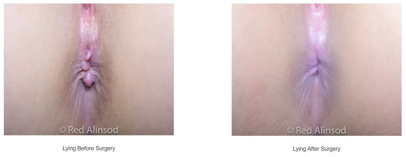 Anal Skin Tags Lake Success Queens Long Island NY