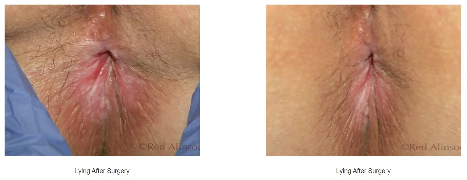 Anal Skin Tags Lake Success Queens Long Island NY