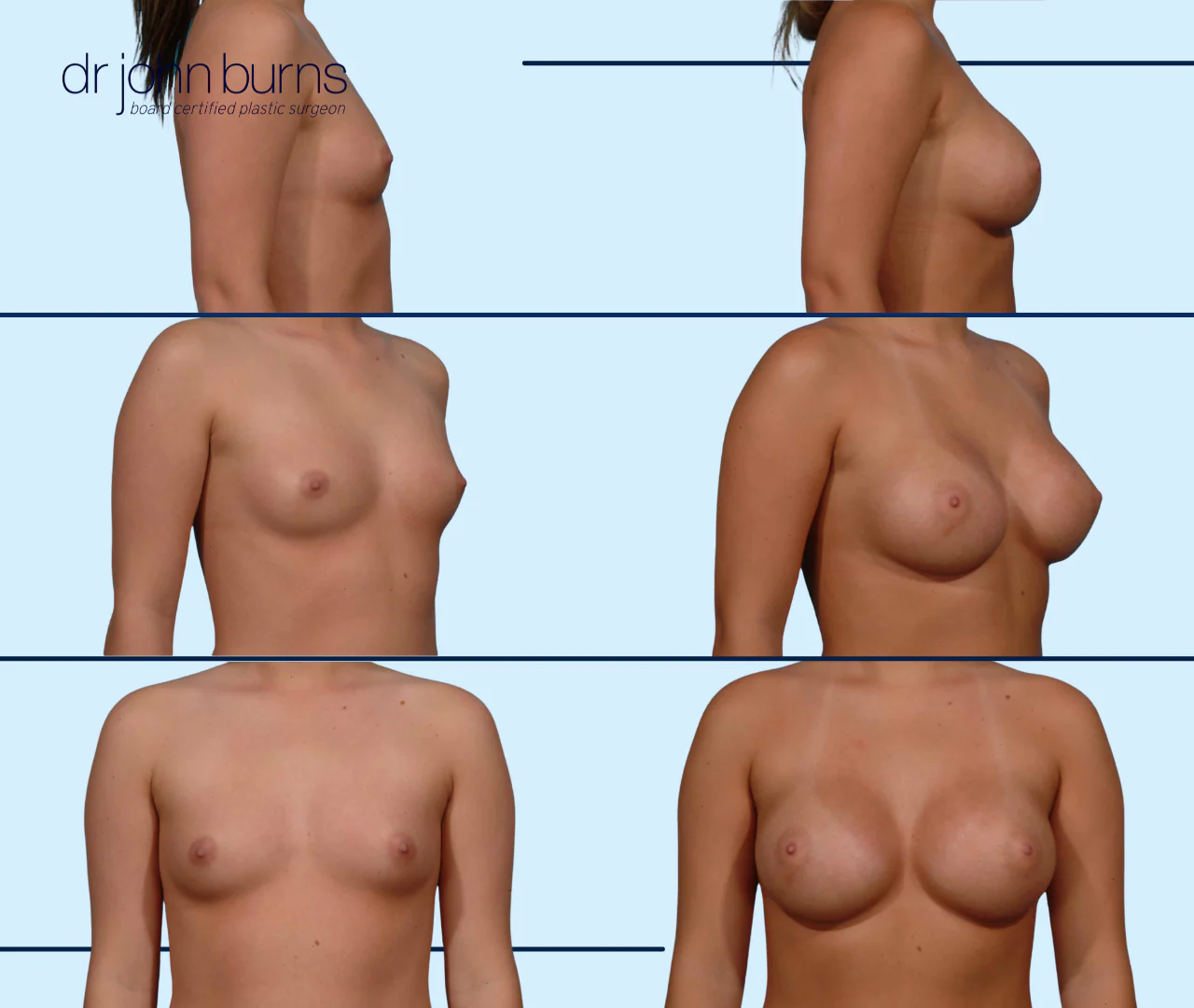 Teardrop Breast Augmentation- Dallas Breast Implants- Dr. John Burns