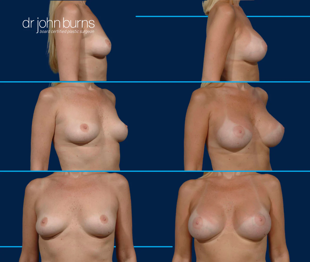 Teardrop Breast Augmentation- Dallas Breast Implants- Dr. John Burns