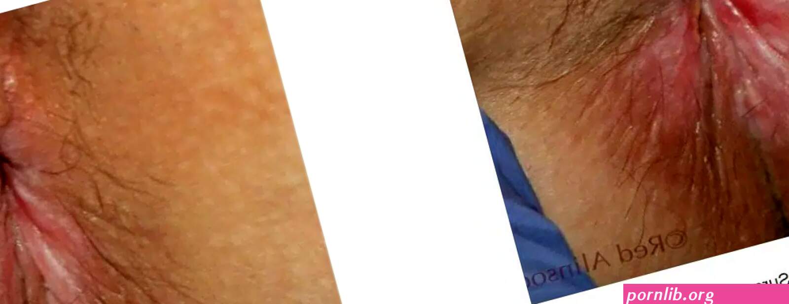 Anal Skin Tags Lake Success Queens Long Island NY