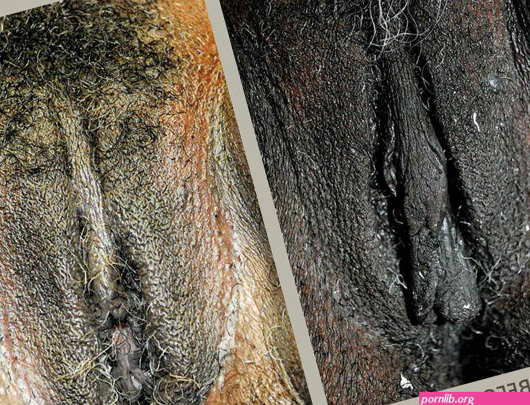Vaginal and Anal Bleaching Before and After Pictures in Orlando FL
