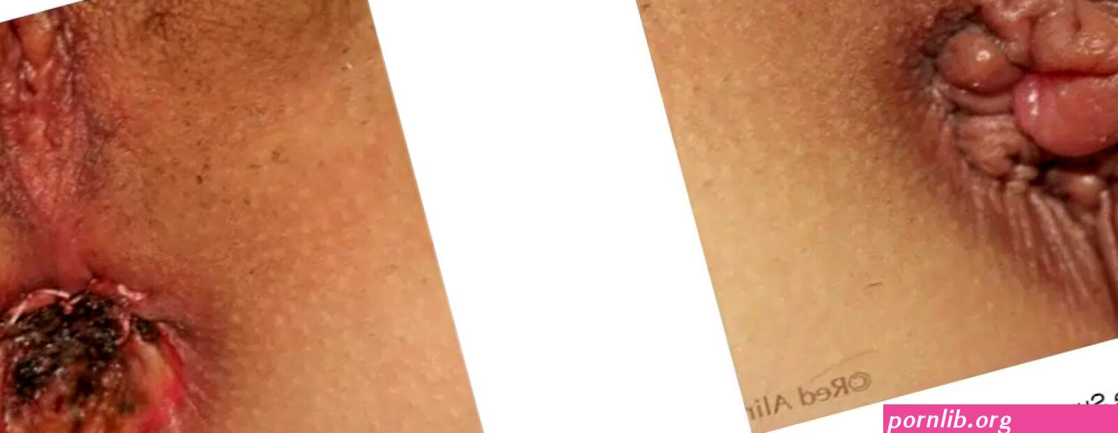 Anal Skin Tags Lake Success Queens Long Island NY